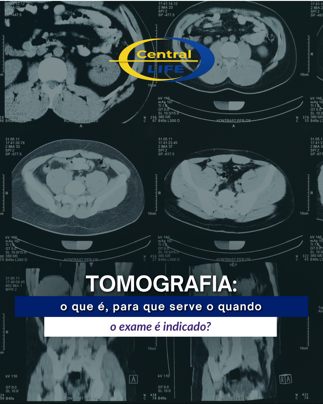 Tomografia: o que é, para que serve e quando o exame é indicado?